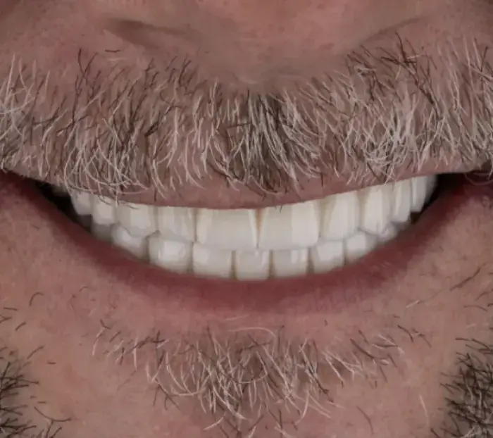 Smile transformation 7 — after