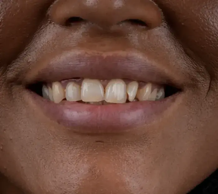 Smile transformation 11 — before