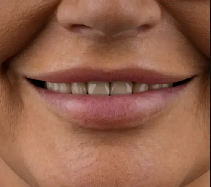 Smile transformation 10 — before