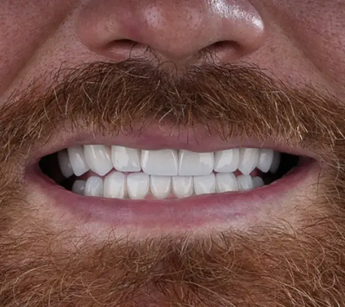 Smile transformation 6 — after