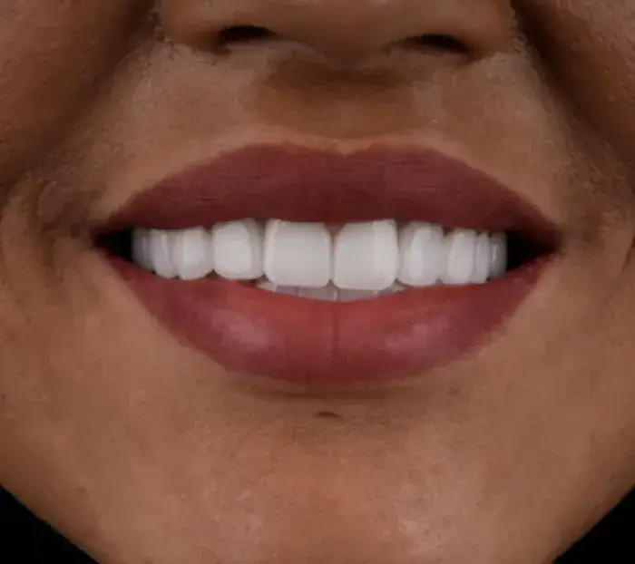 Smile transformation 11 — after