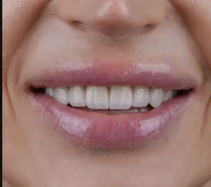 Smile transformation 12 — after
