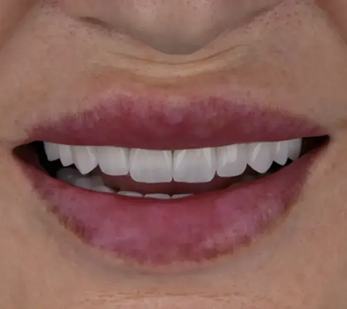 Smile transformation 8 — after
