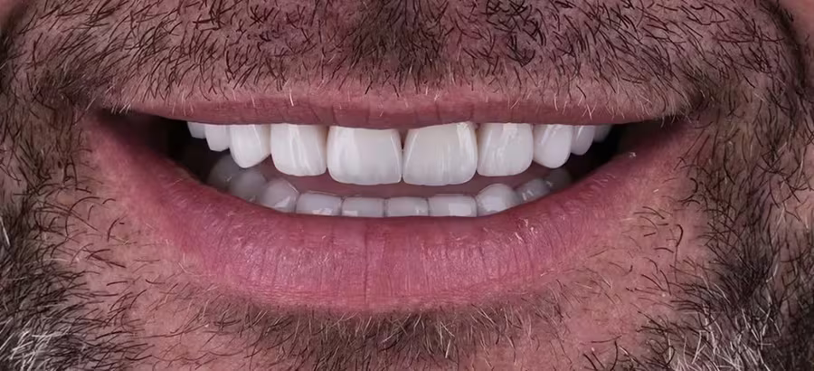 Smile transformation 1 — after