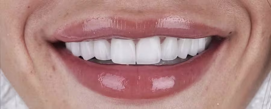 Smile transformation 3 — after
