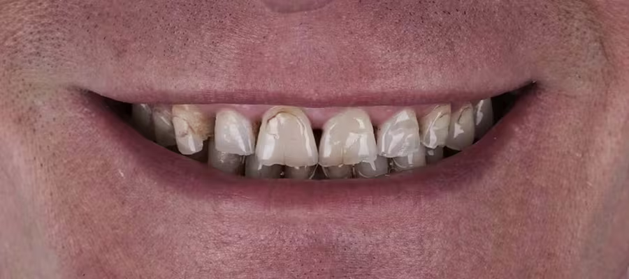 Smile transformation 2 — before